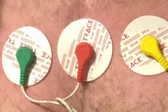 Holter ρυθμού (Holter καρδιάς) Νέα Σμύρνη.