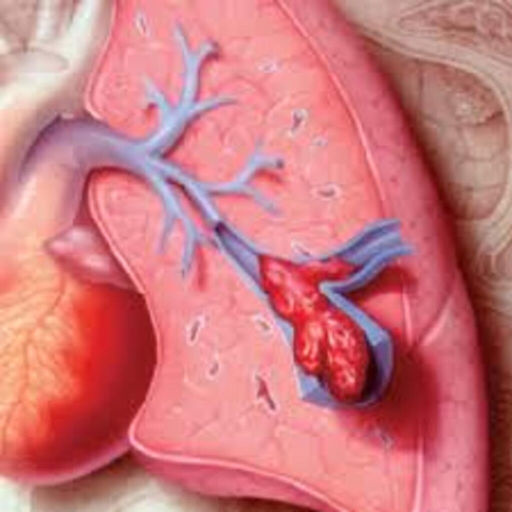 Περιστατικό πνευμονικής εμβολής.ΆΡθρο του καρδιολόγου Νίκου Παναγιωτόπουλου